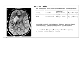 ISCHEMIC STROKE
Goal: To see edema of an early infarct [the first few hours after the onset of symptoms.]
Sequence T1 - weighted
FLAIR (fluid-
attenuated inversion
recovery)
T2-weighted images
Signal Low signal intensity High signal intensity High signal intensity
Conventional MRI is more sensitive and specific than CT for the detection of acute
ischemic brain infarcts, within the first few hours after the onset of symptoms.
Axial proton density (PD) sequence. There is increased signal intensity (arrow)
due to restricted diffusion characteristic of an infarct
 
