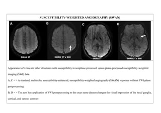 SUSCEPTIBILITY-WEIGHTED ANGIOGRAPHY (SWAN)
Appearance of veins and other structures with susceptibility in nonphase-processed versus phase-processed susceptibility-weighted
imaging (SWI) data.
A, C = > A standard, multiecho, susceptibility-enhanced, susceptibility-weighted angiography (SWAN) sequence without SWI phase
postprocessing.
B, D = > The post hoc application of SWI postprocessing to the exact same dataset changes the visual impression of the basal ganglia,
cortical, and venous contrast
 