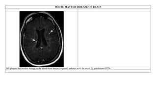 WHITE MATTER DISEASE OF BRAIN
MS plaques that involve damage to the blood-brain barrier frequently enhance with the use of IV gadolinium-DTPA
 