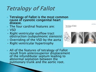  Tetralogy of Fallot is the most common
cause of cyanotic congenital heart
disease.
 The four cardinal features are:
• VSD
• Right ventricular outflow tract
obstruction (subpulmonic stenosis)
• Overriding of the VSD by the aorta
• Right ventricular hypertrophy
 All of the features of tetralogy of Fallot
result from anterosuperior displacement
of the infundibular septum leading to
abnormal septation between the
pulmonary trunk and the aortic root.
 