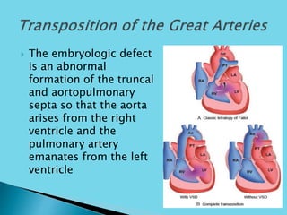  The embryologic defect
is an abnormal
formation of the truncal
and aortopulmonary
septa so that the aorta
arises from the right
ventricle and the
pulmonary artery
emanates from the left
ventricle
 