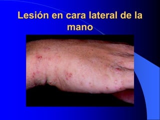 Lesión en cara lateral de la
mano
 
