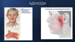 АДЕНОЇДИ
 