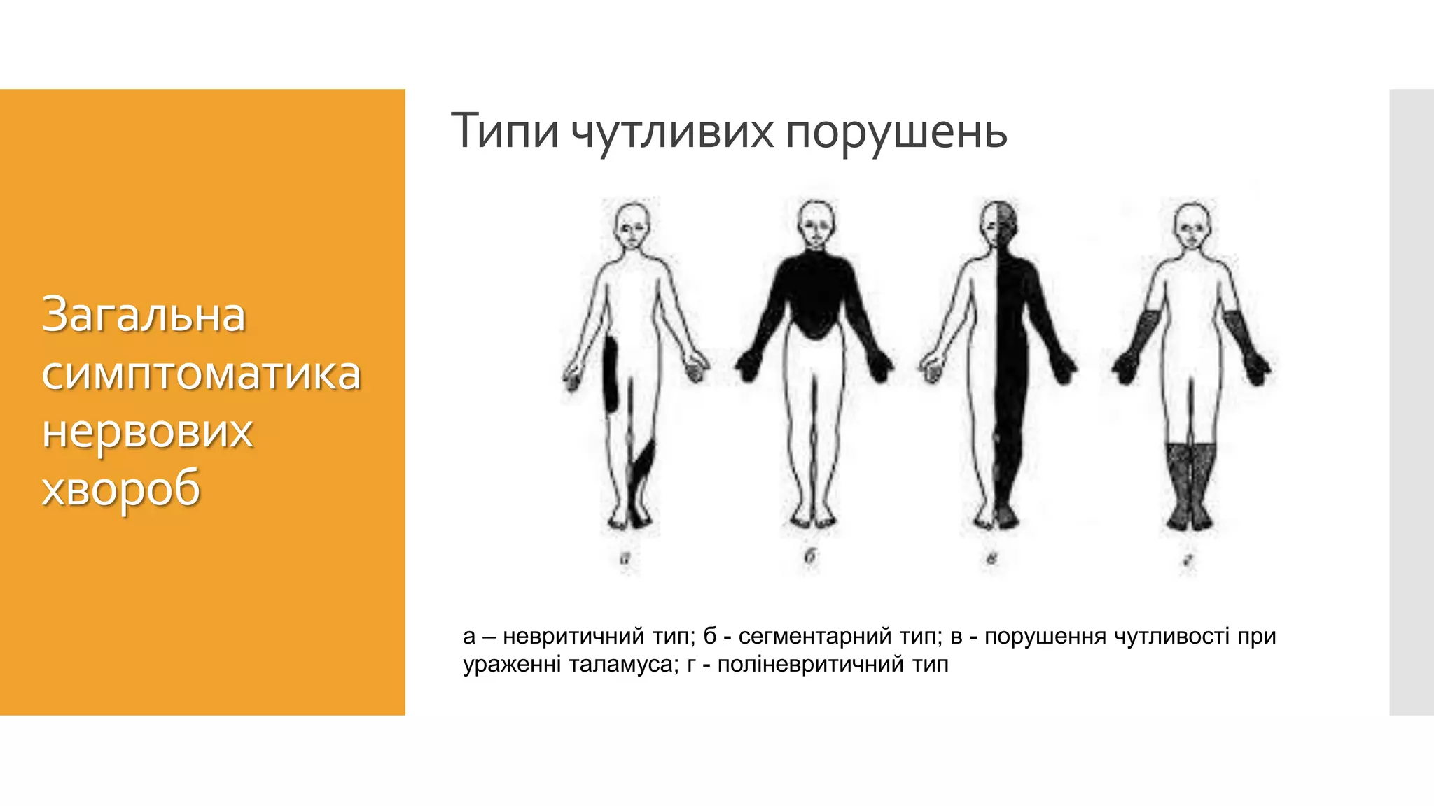 Типи чутливих порушень
Загальна
симптоматика
нервових
хвороб
а – невритичний тип; б - сегментарний тип; в - порушення чутливості при
ураженні таламуса; г - поліневритичний тип
 