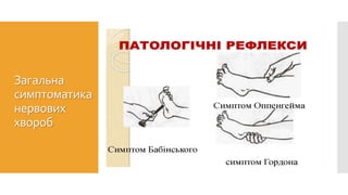 Загальна
симптоматика
нервових
хвороб
 