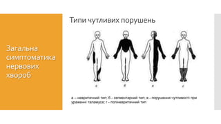 Типи чутливих порушень
Загальна
симптоматика
нервових
хвороб
а – невритичний тип; б - сегментарний тип; в - порушення чутливості при
ураженні таламуса; г - поліневритичний тип
 