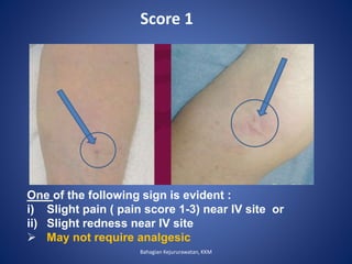 One of the following sign is evident :
i) Slight pain ( pain score 1-3) near IV site or
ii) Slight redness near IV site
 May not require analgesic
Score 1
Bahagian Kejururawatan, KKM
 