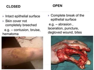 CLOSED
 Intact epithelial surface
 Skin cover not
completely breeched
e.g. – contusion, bruise,
hematoma
OPEN
 Complete break of the
epithelial surface
e.g. – abrasion ,
laceration, puncture,
degloved wound, bites
3/31/2023
wound healing
4
 