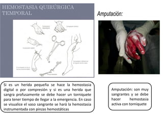 Si es un herida pequeña se hace la hemostasia
digital o por compresión y si es una herida que
sangra profusamente se debe hacer un torniquete
para tener tiempo de llegar a la emergencia. En caso
se visualice el vaso sangrante se hará la hemostasia
instrumentada con pinzas hemostáticas
Amputación: son muy
sangrantes y se debe
hacer hemostasia
activa con torniquete
 