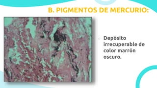B. PIGMENTOS DE MERCURIO:
• Depósito
irrecuperable de
color marrón
oscuro.
 