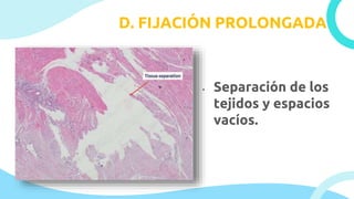D. FIJACIÓN PROLONGADA
• Separación de los
tejidos y espacios
vacíos.
 