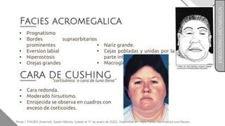 Facies acromegalica
• Prognatismo
• Bordes supraorbitarios
prominentes
• Eversion labial
• Hiperostosis
• Orejas grandes
• Nariz grande.
• Cejas pobladas y unidas por la
parte interna.
• Macroglosia (lengua grande).
CARA DE CUSHING
• Cara redonda.
• Moderado hirsutismo.
• Enrojecida se observa en cuadros con
exceso de corticoides.
“cortisónica o cara de luna llena”
ENDÓCRINO-METABÓLICA
Rivas I. FACIES [Internet]. Gastro Mérida. [citado el 17 de enero de 2022]. Disponible en: https://www.ivanrivasmd.com/facies/
 