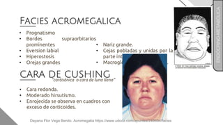 Facies acromegalica
• Prognatismo
• Bordes supraorbitarios
prominentes
• Eversion labial
• Hiperostosis
• Orejas grandes
• Nariz grande.
• Cejas pobladas y unidas por la
parte interna.
• Macroglosia (lengua grande).
CARA DE CUSHING
• Cara redonda.
• Moderado hirsutismo.
• Enrojecida se observa en cuadros con
exceso de corticoides.
“cortisónica o cara de luna llena”
ENDÓCRINO-METABÓLICA
Dayana Flor Vega Benito. Acromegalia https://www.udocz.com/apuntes/248694/facies
 