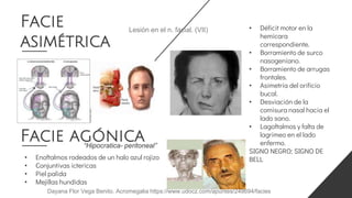Facie
asimétrica
• Déficit motor en la
hemicara
correspondiente.
• Borramiento de surco
nasogeniano.
• Borramiento de arrugas
frontales.
• Asimetría del orificio
bucal.
• Desviación de la
comisura nasal hacia el
lado sano.
• Lagoftalmos y falta de
lagrimeo en el lado
enfermo.
SIGNO NEGRO; SIGNO DE
BELL
Lesión en el n. facial. (VII)
• Enoftalmos rodeados de un halo azul rojizo
• Conjuntivas ictericas
• Piel palida
• Mejillas hundidas
Facie agónica
“Hipocratica- peritoneal”
Dayana Flor Vega Benito. Acromegalia https://www.udocz.com/apuntes/248694/facies
 