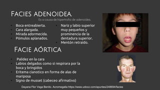 • Boca entreabierta.
• Cara alargada.
• Mirada adormecida.
• Pómulos aplanados.
• Nariz y labio superior
muy pequeños y
prominencia de la
dentadura superior.
• Mentón retraído.
Facie aórtica
• Palidez en la cara
• Labios delgados como si respirara por la
boca y bringidos
• Eritema cianotico en forma de alas de
mariposa
• Signo de musset (cabeceo afirmativo)
Dayana Flor Vega Benito. Acromegalia https://www.udocz.com/apuntes/248694/facies
Facies adenoidea.
Es a causa de hipertrofia de adenoides.
 