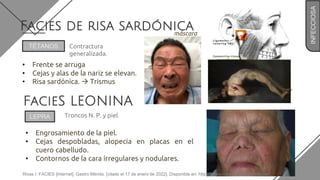 • Engrosamiento de la piel.
• Cejas despobladas, alopecia en placas en el
cuero cabelludo.
• Contornos de la cara irregulares y nodulares.
FacieS LEONINA
Facies de risa sardónica
• Frente se arruga
• Cejas y alas de la nariz se elevan.
• Risa sardónica.  Trismus
máscara
tetánica.
TÉTANOS Contractura
generalizada.
INFECCIOSA
LEPRA Troncos N. P. y piel
Rivas I. FACIES [Internet]. Gastro Mérida. [citado el 17 de enero de 2022]. Disponible en: https://www.ivanrivasmd.com/facies/
 