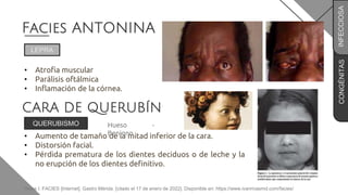CONGÉNITAS
Facies ANTONINA
• Atrofia muscular
• Parálisis oftálmica
• Inflamación de la córnea.
LEPRA
INFECCIOSA
CARA DE QUERUBÍN
• Aumento de tamaño de la mitad inferior de la cara.
• Distorsión facial.
• Pérdida prematura de los dientes deciduos o de leche y la
no erupción de los dientes definitivo.
QUERUBISMO Hueso -
Benigno
Rivas I. FACIES [Internet]. Gastro Mérida. [citado el 17 de enero de 2022]. Disponible en: https://www.ivanrivasmd.com/facies/
 