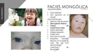 FACIES MONGÓLICA
Síndrome de Down
• Cara redonda
• Con epicanto en el
ángulo
interno de los ojos
• Nariz en silla de montar
• Macroglosia relativa.
• Orejas de
implantación baja.
• Rostro aplanado
• Cabeza pequeña
• Cuello corto
• Poco tono muscular
• Pequeñas manchas
blancas en la parte de
color del ojo (iris)
denominadas
«manchas de
Brushfield»
CONGÉNITAS
 