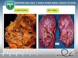 CARCINOMA SỎI THẬN
 