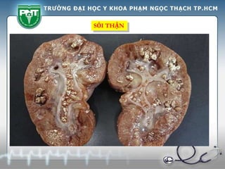 SỎI THẬN
 