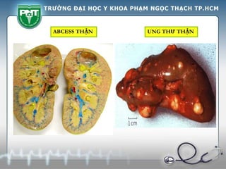 ABCESS THẬN UNG THƯ THẬN
 