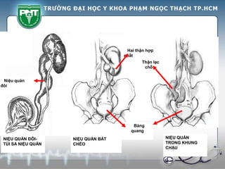 Hai thận hợp
nhất
Bàng
quang
Thận lạc
chỗ
NIỆU QUẢN ĐÔI-
TÚI SA NIỆU QUẢN
NIỆU QUẢN BẮT
CHÉO
NIỆU QUẢN
TRONG KHUNG
CHẬU
Niệu quản
đôi
 