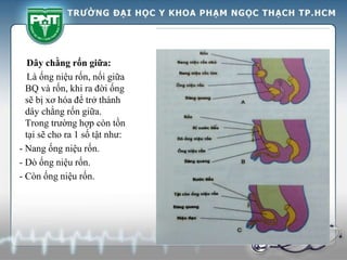 Dây chằng rốn giữa:
Là ống niệu rốn, nối giữa
BQ và rốn, khi ra đời ống
sẽ bị xơ hóa để trở thành
dây chằng rốn giữa.
Trong trường hợp còn tồn
tại sẽ cho ra 1 số tật như:
- Nang ống niệu rốn.
- Dò ống niệu rốn.
- Còn ống niệu rốn.
 