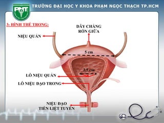 LỖ NIỆU ĐẠO TRONG
LỖ NIỆU QUẢN
NIỆU QUẢN
NIỆU ĐẠO
TIỀN LIỆT TUYẾN
DÂY CHẰNG
RỐN GIỮA
2,5 cm
5 cm
3- HÌNH THỂ TRONG:
 
