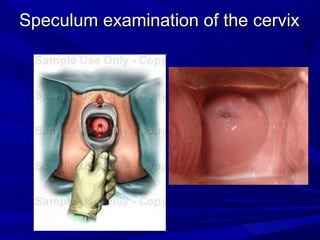 Speculum examination of the cervix
Speculum examination of the cervix
 