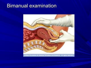 Bimanual examination
Bimanual examination
 