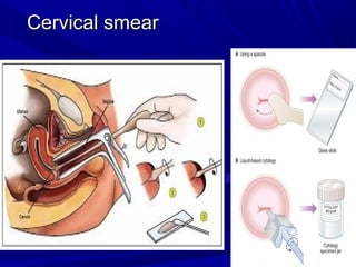 Cervical smear
Cervical smear
 