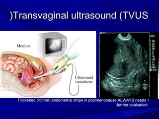 Transvaginal ultrasound (TVUS
Transvaginal ultrasound (TVUS
(
(
•
Thickened (>5mm( endometrial stripe in postmenopause ALWAYS needs
further evaluation
.
 