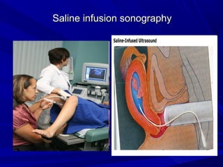 Saline infusion sonography
Saline infusion sonography
 