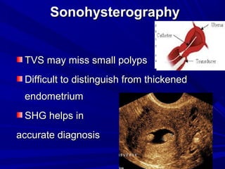 Sonohysterography
Sonohysterography
TVS may miss small polyps
TVS may miss small polyps
Difficult to distinguish from thickened
Difficult to distinguish from thickened
endometrium
endometrium
SHG helps in
SHG helps in
accurate diagnosis
accurate diagnosis
 