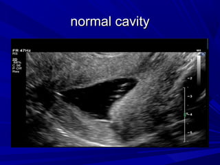 normal cavity
normal cavity
 