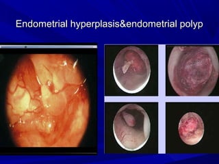 Endometrial hyperplasis&endometrial polyp
Endometrial hyperplasis&endometrial polyp
 