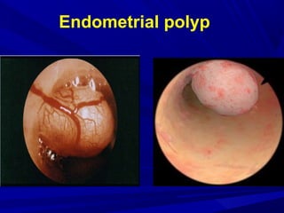 Endometrial polyp
 