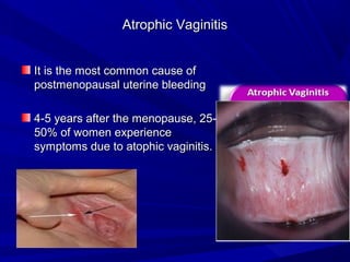 Atrophic Vaginitis
Atrophic Vaginitis
It is the most common cause of
It is the most common cause of
postmenopausal uterine bleeding
postmenopausal uterine bleeding
4-5 years after the menopause, 25-
4-5 years after the menopause, 25-
50% of women experience
50% of women experience
symptoms due to atophic vaginitis.
symptoms due to atophic vaginitis.
 