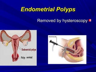Endometrial Polyps
Endometrial Polyps
Removed by hysteroscopy
Removed by hysteroscopy
 
