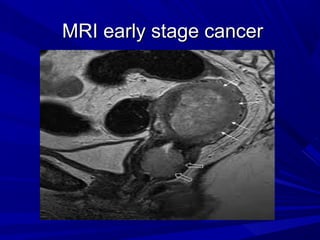 MRI early stage cancer
MRI early stage cancer
 