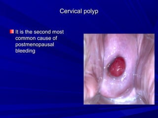 Cervical polyp
Cervical polyp
It is the second most
It is the second most
common cause of
common cause of
postmenopausal
postmenopausal
bleeding
bleeding
 