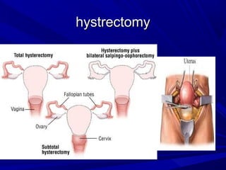 hystrectomy
hystrectomy
 
