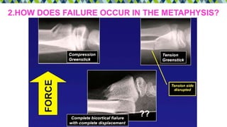 2.HOW DOES FAILURE OCCUR IN THE METAPHYSIS?
 