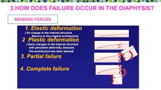 3.HOW DOES FAILURE OCCUR IN THE DIAPHYSIS?
BENDING FORCES
 