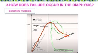 3.HOW DOES FAILURE OCCUR IN THE DIAPHYSIS?
BENDING FORCES
 