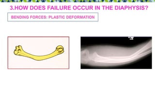 3.HOW DOES FAILURE OCCUR IN THE DIAPHYSIS?
BENDING FORCES: PLASTIC DEFORMATION
 