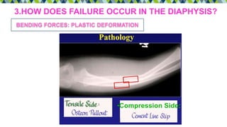 3.HOW DOES FAILURE OCCUR IN THE DIAPHYSIS?
BENDING FORCES: PLASTIC DEFORMATION
 