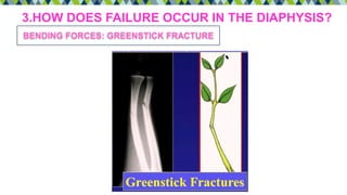 3.HOW DOES FAILURE OCCUR IN THE DIAPHYSIS?
BENDING FORCES: GREENSTICK FRACTURE
 
