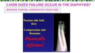 3.HOW DOES FAILURE OCCUR IN THE DIAPHYSIS?
BENDING FORCES: GREENSTICK FRACTURE
 