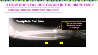 3.HOW DOES FAILURE OCCUR IN THE DIAPHYSIS?
BENDING FORCES: COMPLETE FRACTURE
 